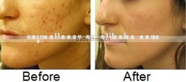 Best Glass Tube 10600nm Fractional Co2 Laser