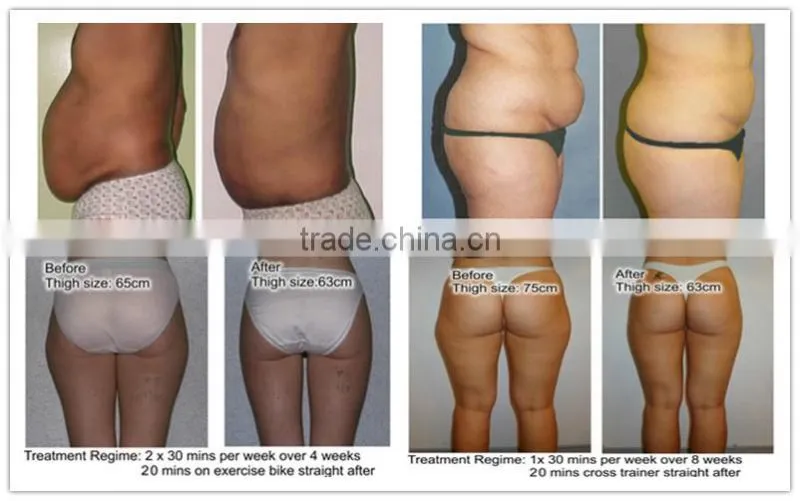 2015 new design ultrasonic beauty machine,criolipolisys machine,cryolipolysis radiofrequency