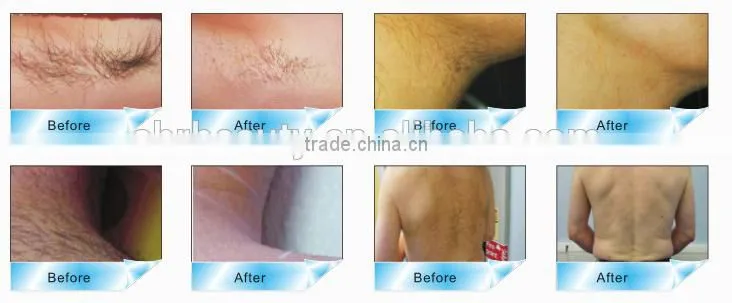 High Quality Laser IPL Machine For Face Wrinkles