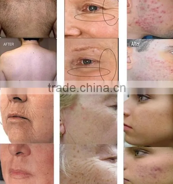 2014 best price ultrasonic cavitation machine from China