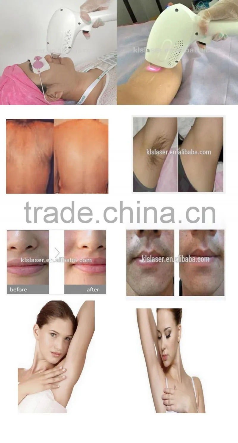 2015 permanent hair removal 808nm diode laser for hair removal