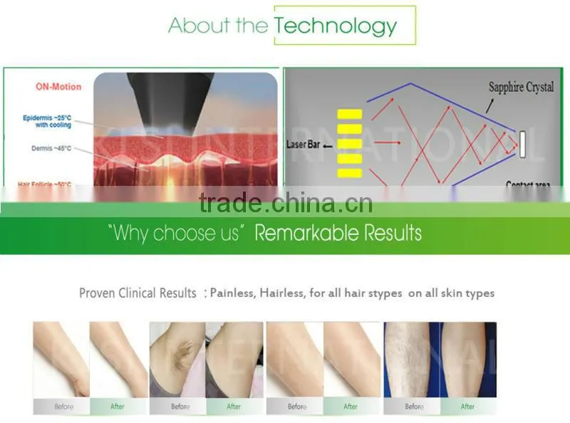 Wholsale High Quality 808nm Diode Laser Hair Removal Machine