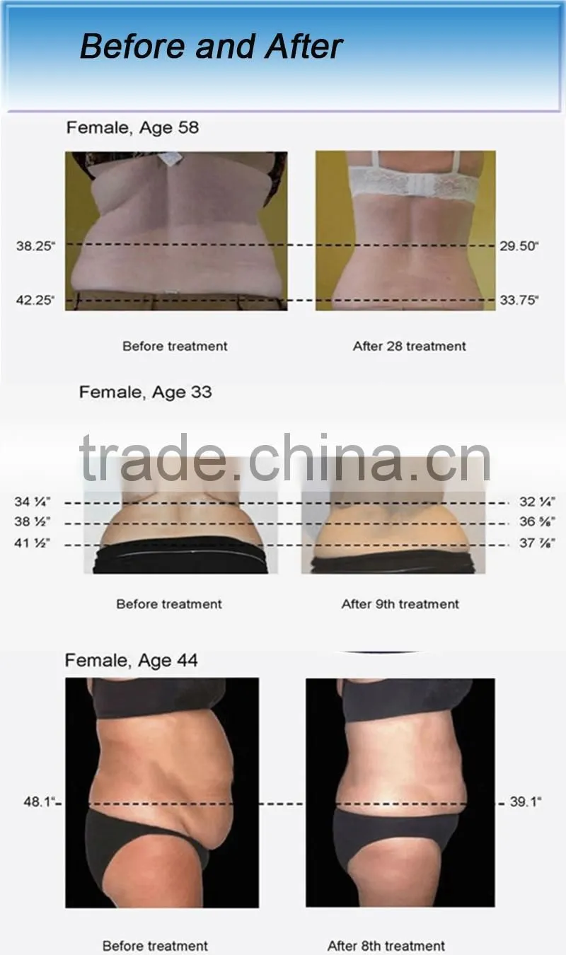 Portable ultrasonic liposuction cavitation fast slimming machine