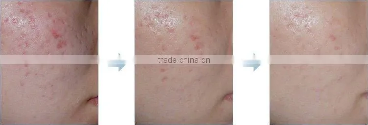 Micro needle LED Theory MT Titanium Derma Roller L004