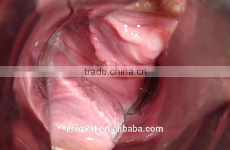 Self Exam Colposcope