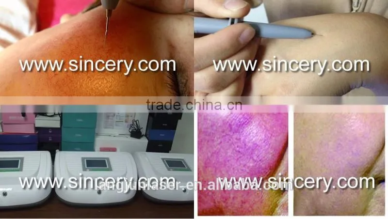 Spider Vein Removal/Vascular Removal