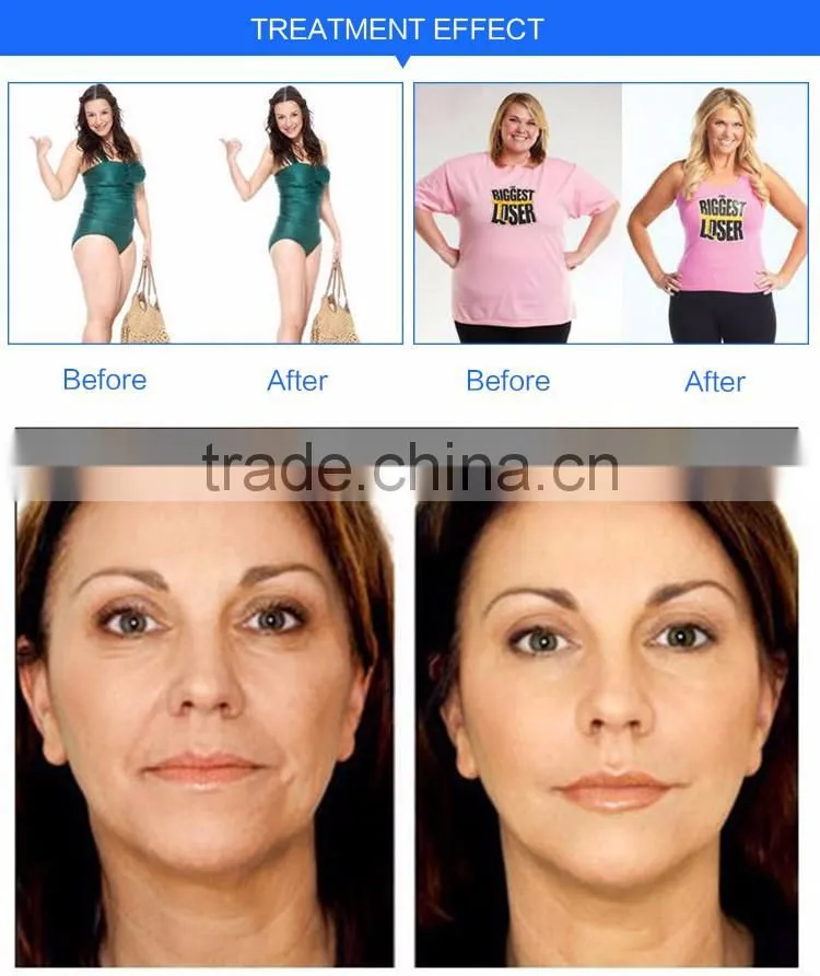 4 in 1 multifunctional multipolar rf cavitation slimming machine