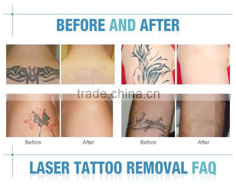Hot sale laser nd yag 1064 nm 532nm nd yag laser machine for tattoo removal