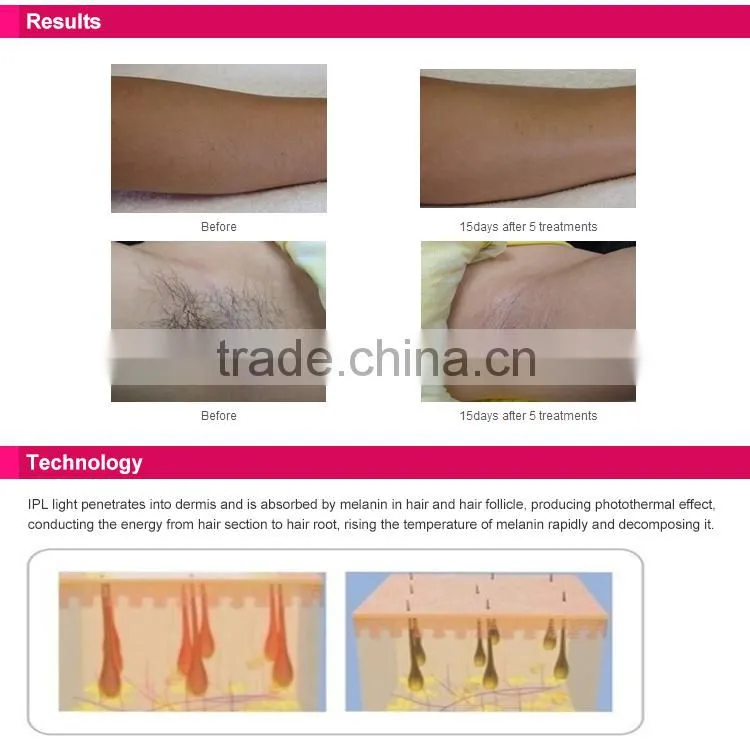 DEESS Home use IPL permanent hair removal device with 300000shots lamp life