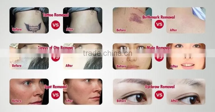 Best effective tattoo removal nd yag q-switch laser