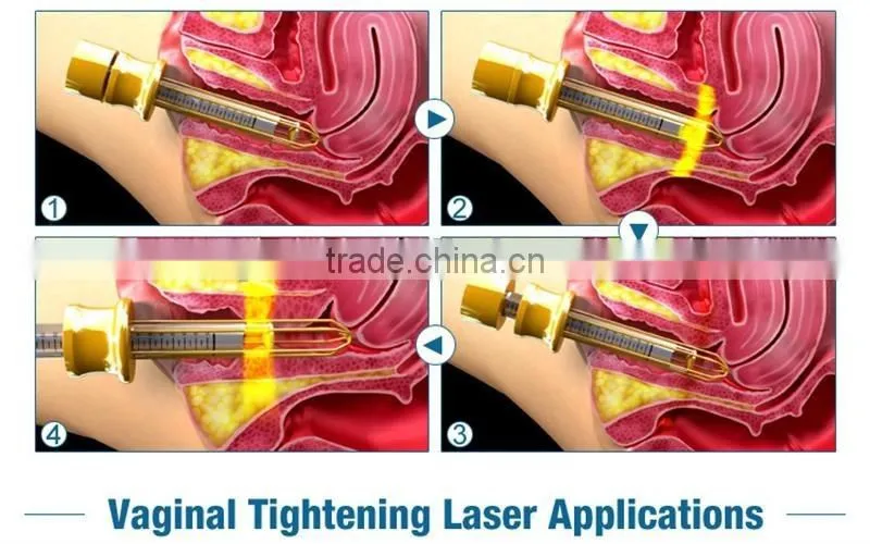 Best promotion price/fractional co2 laser/co2 fractional laser/laser equipment co2 fractional for vaginal tightening