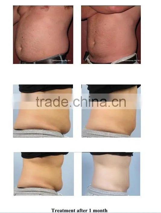 lipo laser vacuum cryo lipo machine