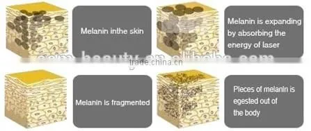 Body care equipment q switch laser tattoo removal equipment