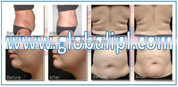 salon use body contouring body slimming fractional radiofrecuency