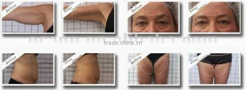 2016 TOP SALE multifunctional cryolipolyse dual lipo laser rf cavitation