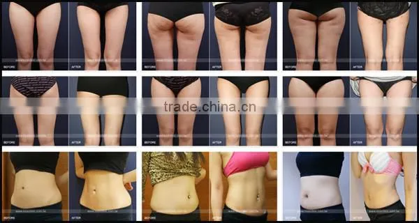 Advanced lipo freeze coolshape fat freezing machine for sale