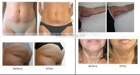 Multi-Frequence RF machine/body contour equipment/face lifting system