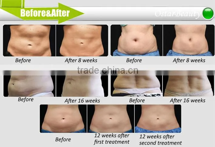 Cryolipolysis machine ultrasonic vacuum liposuction