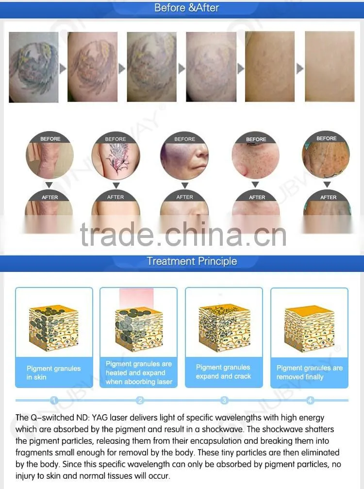 532nm 1064nm 1320nm pigments tattoo removal laser treatment q-switch nd yag laser