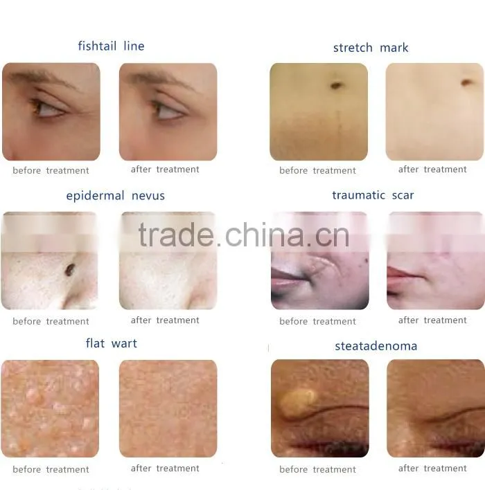 co2 fractional laser machine, best skin resurfacing treatments, fractional laser for scars