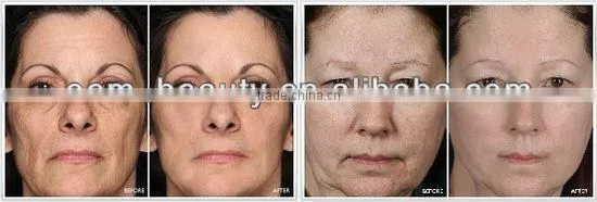 radio frequency face lifting machine