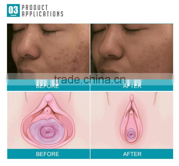 Fractional CO2 laser scar removal stretch mark removal device (With CE)