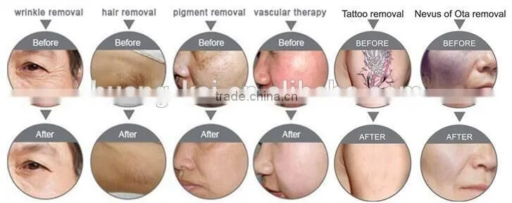laser pigment removal elight hair removal machine