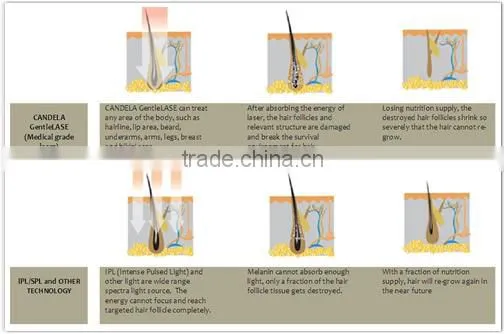 Latest Germany device 808 diode / nd yag hair removal laser