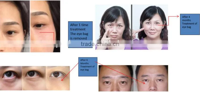 beauty machine eye care system for eye bag removal for wrinkle removal