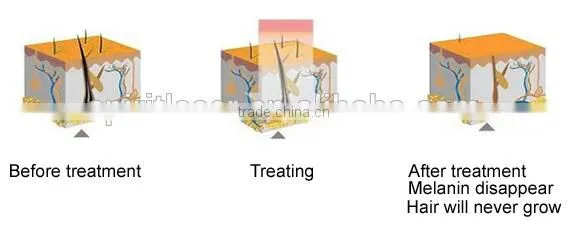 diode laser 808 / diode laser 808nm / diode laser 808nm hair removal