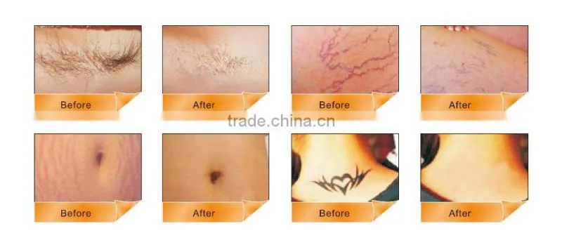 Q switch ND YAG laser tattoo removal cooling RF skin tighten IPL hair removal