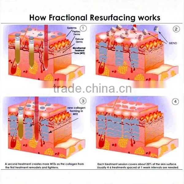 Fractional co2 laser pigment removal women care for vaginafor hospital ,beauty spa and clinic