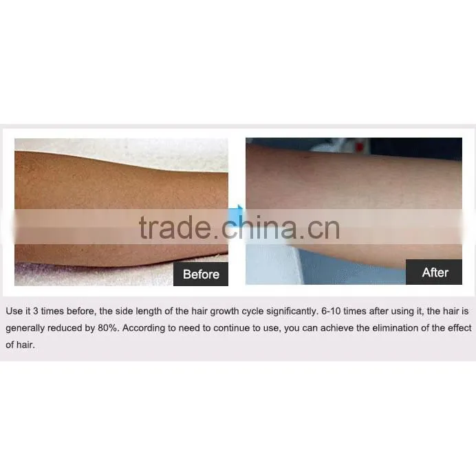 Best Choice Laser Cosmetic Equipment Portable Hair Removal Instrument in USA
