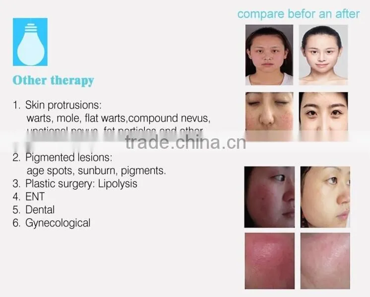 Vascular Removal Spider Vein removal 980nm medical diode laser 16W