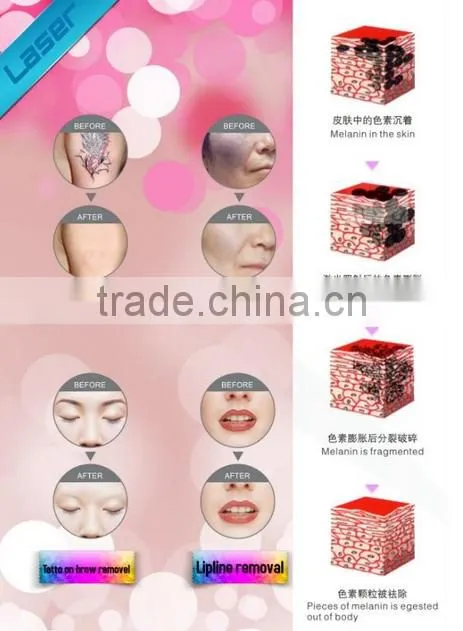 Cheapest 2014 !!!! popular q switch nd yag laser cream tattoo removal