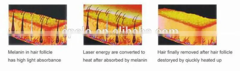 2015 Professional Best Seller 808nm diode laser permanent hair removal device for face from Apolomed