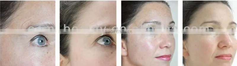 OEM acceptable microneedle roller stretch marks