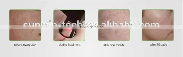 New model co2 facial laser resurfacing