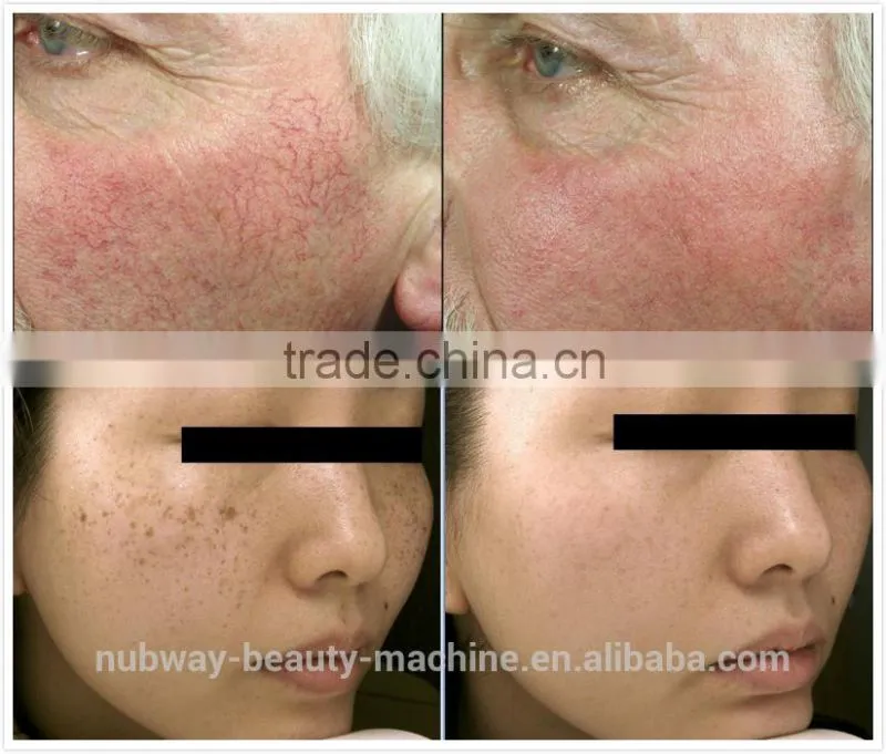 Photo Epilator Facial Rejuvenation Vascular Removal Hair Removal IPL Equipment