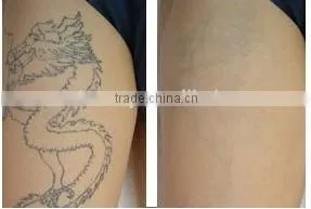 2016 Hottest Home Laser tattoo removal q switch nd yag laser-vascular