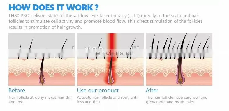 Portable Laser Cap Hair Growth Machine For Treating Bald Sparse Hair