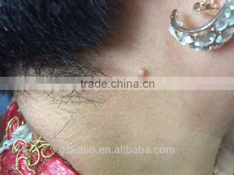 hand-held spot removal machine,high frequency current spot removal