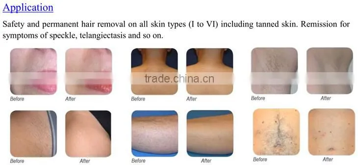 808nm diode depilation laser home hair removal equipment depilation laser home