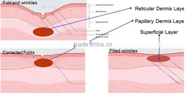 Factory direct sale! Professional skin rejuvenation/ wrinkle removal fractional rf microneedle face treatment