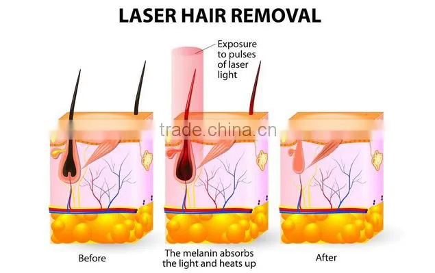 Laser Hair Removal / hair removal laser / laser hair removal machine