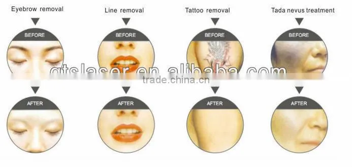 Best choices for beauty salon, strong power q switch nd yag laser skin rejuvenation /tattoo removal removal laser machine