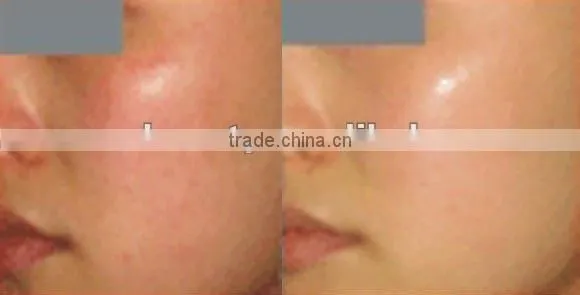2012 Newest IPL+RF Elight machine for red capillary and acne treatment