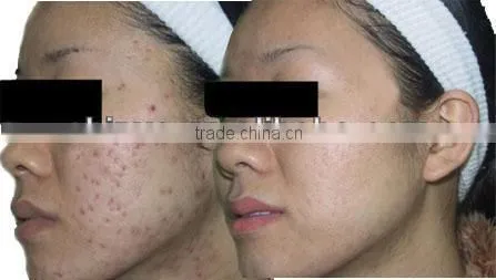 RF tube excited CO2 fractional laser with SFDA and Medical CE