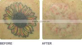 Nd yag laser tattoo removal machine with competitive price