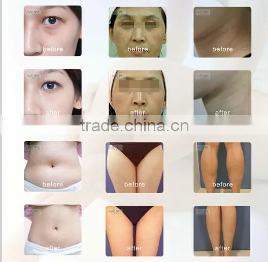 rejuvenational equipment anti-age machine